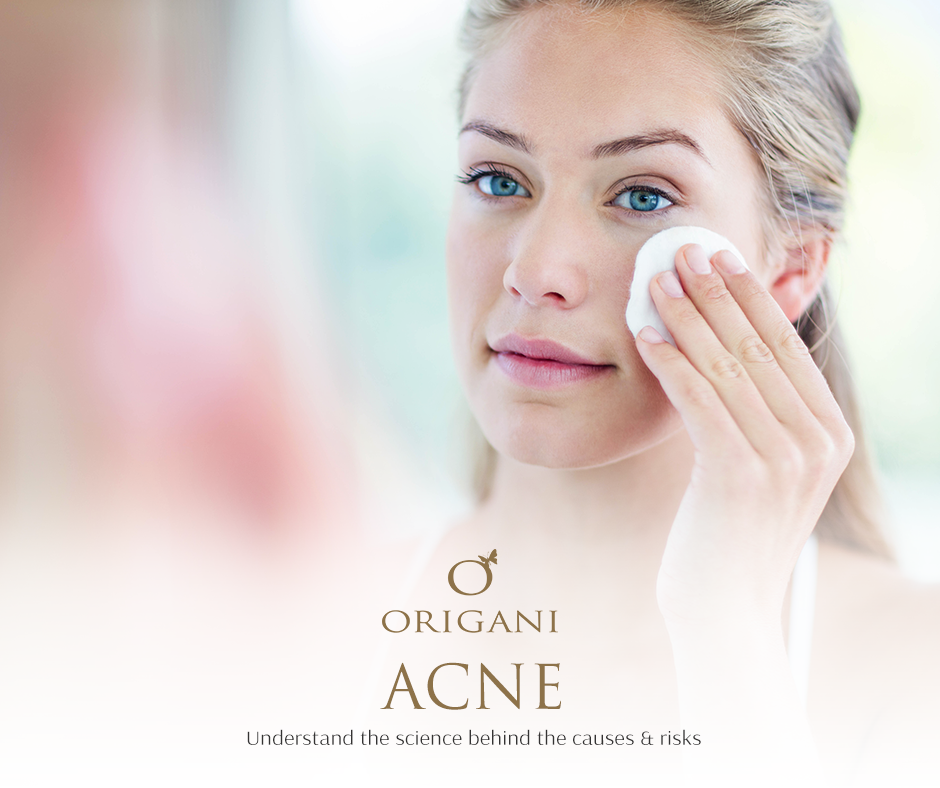 Acne: Understand The Science Behind The Causes And Risks